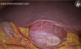 Tissu Hépatique Accessoire sur la Vésicule Biliaire