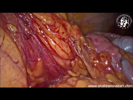 Hémicolectomie Droite Etendue par Laparoscopie - Cancer du Caecum