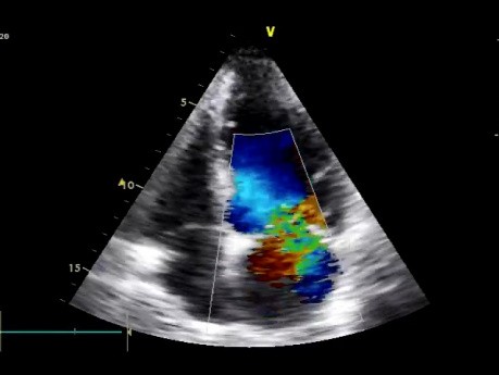 La rupture du muscle papillaire cardiaque - la cause de l'insuffisance mitrale aiguë