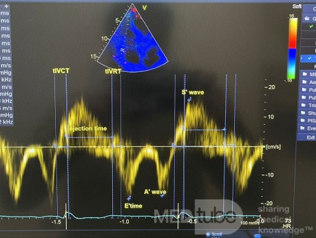 Fonction Diastolique du VD par Doppler Tissulaire et Indice Tei