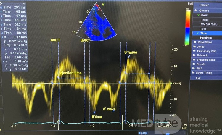 Fonction Diastolique du VD par Doppler Tissulaire et Indice Tei