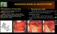 Mastectomie radicale modifiée - Aspects théoriques