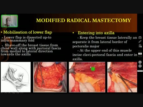 Mastectomie radicale modifiée - Aspects théoriques