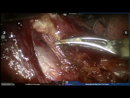 Segmentectomie pulmonaire anatomique assistée par robot 