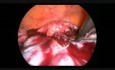 Prise en charge laparoscopique des métastases ovariennes bilatérales