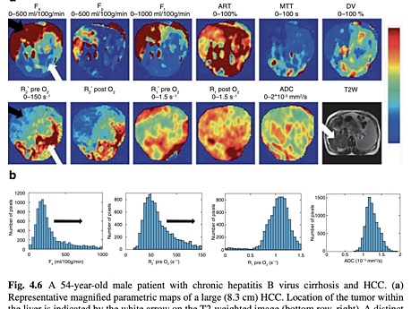 Carcinome hépatocellulaire