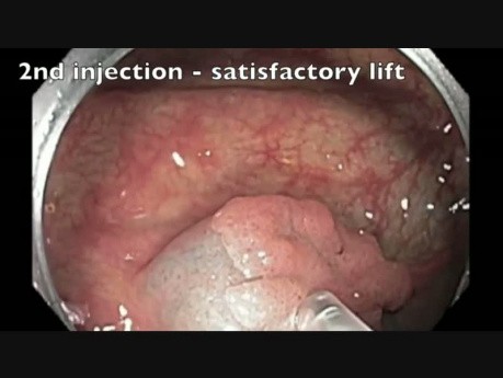 Côlon: Résection Muqueuse Endoscopique compliquée d'une perforation - partie 3