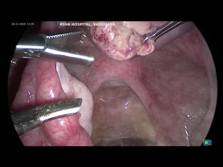 Myomectomie laparoscopique 1 fibrome de la paroi latérale