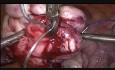 Myomectomie d'un fibrome dans la paroi postérieure