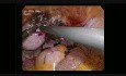 Chirurgie laparoscopique de la grossesse cornuale droite