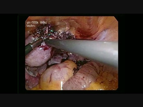 Chirurgie laparoscopique de la grossesse cornuale droite