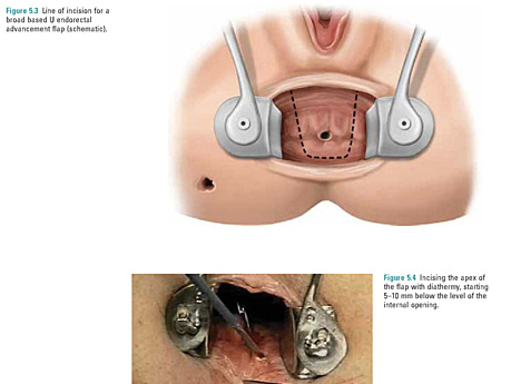 Chirurgie du côlon et rectale - opérations anorectales