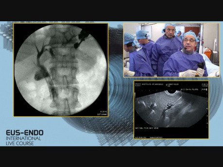 Hépaticogastrostomie guidée sous écho-endoscopie (EUS-HG)