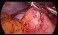 Pyloroplastie laparoscopique de Heineke-Mikulicz