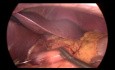 Passage de Sleeve Gastrique en Bypass Gastrique pour RGO