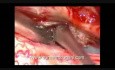 Tumeur Médullaire - Méningiome Intradural Rachidien - Excision Microchirurgicale