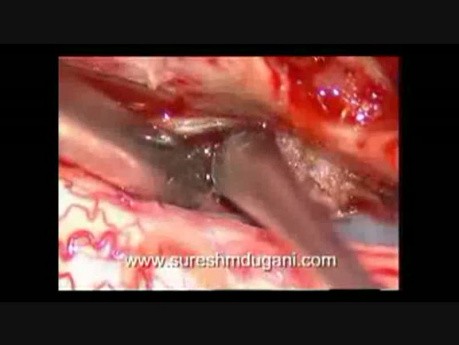 Tumeur Médullaire - Méningiome Intradural Rachidien - Excision Microchirurgicale