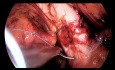 Réparation latérale pré-péritonéale du prolapsus génital  par voie laparoscopique - une nouvelle approche