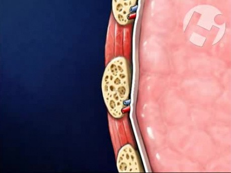 Fractures des côtes et l'hémothorax consécutive à un accident