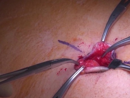 Les Pièges de la Chirurgie Intragastrique dans le Traitement des Tumeurs Stromales Gastriques