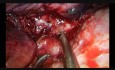 Lobectomie en manchon (sleeve lobectomie) d'une tumeur pulmonaire, la chirurgie thoracique vidéo-assistée uniportale (CTVA-U)  