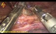 Œsophagectomie Thoraco-Laparoscopique - Partie Thoracique 5