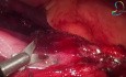 Chirurgie Bariatrique Laparoscopique Révisionnelle Après Pontage Gastrique Ouvert avec Anneau en Silastic