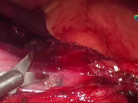 Chirurgie Bariatrique Laparoscopique Révisionnelle Après Pontage Gastrique Ouvert avec Anneau en Silastic