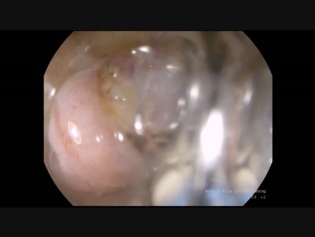 Dissection Endoscopique Sous-Muqueuse (DSM ) du lipome duodénal 
