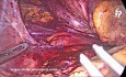 Résection de Sac Volumineux Herniaire Hiatal Volumineux