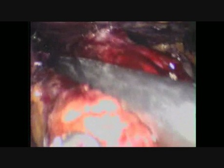 Réopération: la gastrectomie en manchon après la gastroplastie à bandes verticales