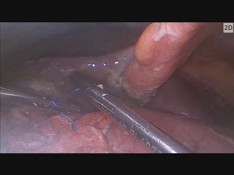  Traitement laparoscopique de l'ulcère pylorique perforé