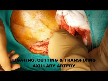 Le traitement chirurgical  du sarcome de l'humérus - chirurgie de  l'articulation de l'épaule.