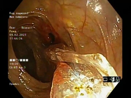 Dilatation par ballonnet de la sténose