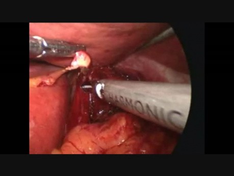 Vagotomie tronculaire laparoscopique et GJ