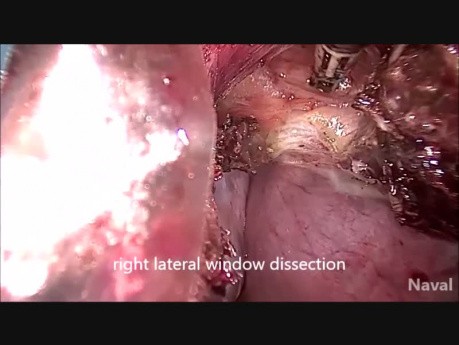 Difficile vNOTES Hystérectomie pour les deux précédents utérus fibroïde cicatrisé par césarienne