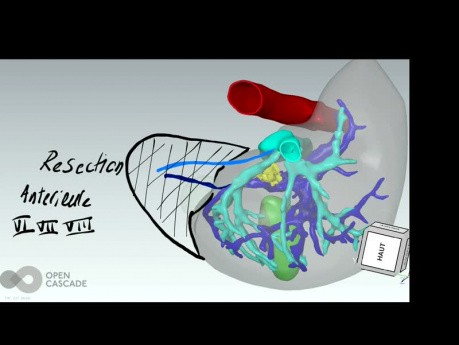 La reconstruction tridimensionnelle dans la planification d’une chirurgie hépatique complexe