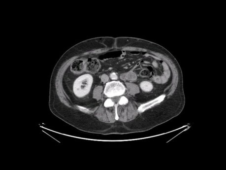 Présentation de Cas - Trisectionectomie Gauche avec Loboectomie Caudée pour Cholangiocarcinome Intra-hépatique