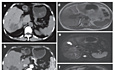 Cholangiocarcinome intrahépatique