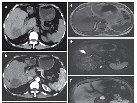 Cholangiocarcinome intrahépatique