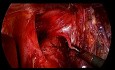 Gastrectomie totale cœlioscopique pour cancer de l'estomac