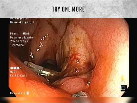 Lit Vasculaire Post Dissection Sous-Muqueuse (ESD) vs Anciens Clips