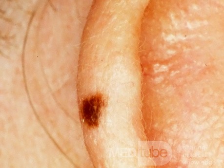 Nevus jonctionnel