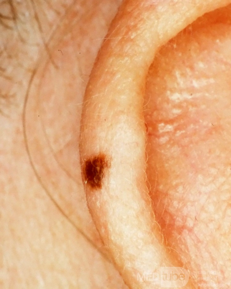 Nevus jonctionnel