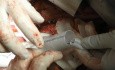 Réparation chirurgicale ouverte de l'anévrisme de l'aorte thoracoabdominale