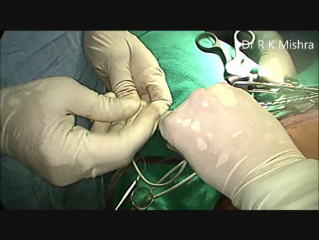 Hystérectomie laparoscopique totale (TLH)