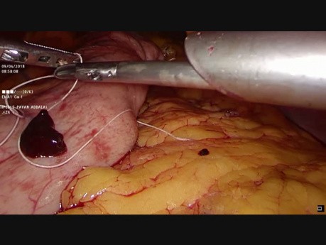 Plicature Gastrique Laparoscopique