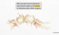 Prise en Charge des Fractures Comminutives du Condyle Mandibulaire