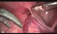 Herniotomie laparoscopique