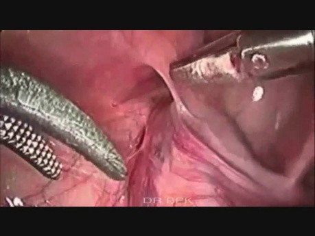 Herniotomie laparoscopique